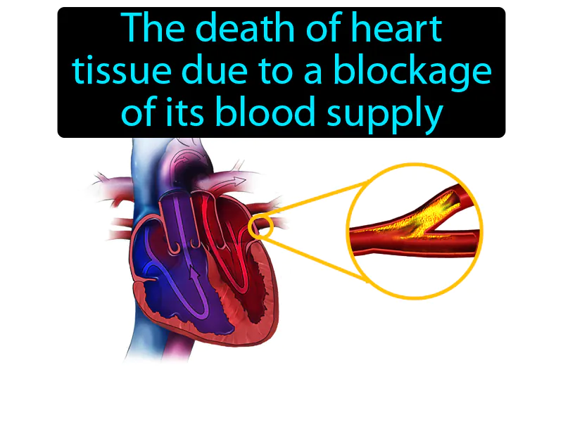 Heart Attack Definition Heart Attack Definition