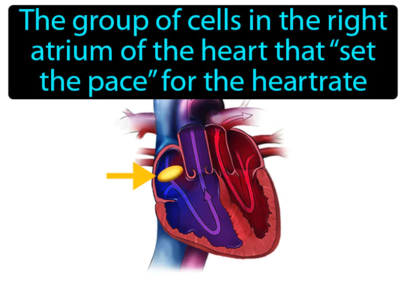 Pacemaker Definition
