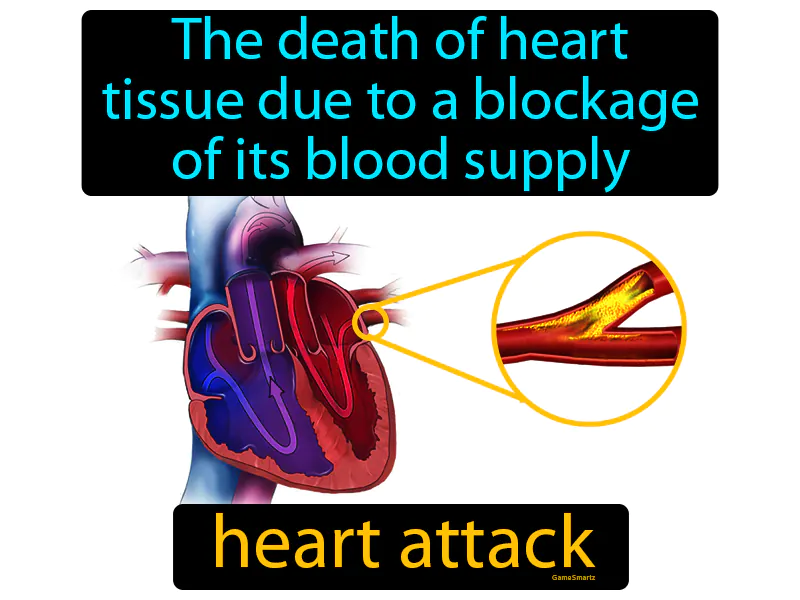Heart Attack Definition Heart Attack Definition